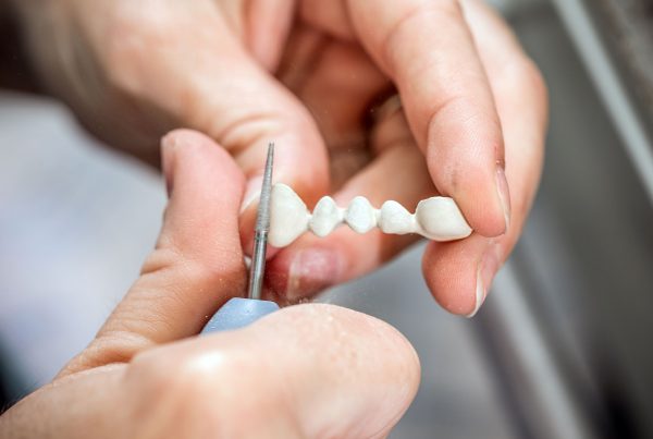Dental Bridge