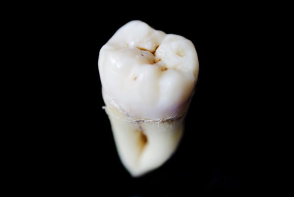 Teeth Extraction