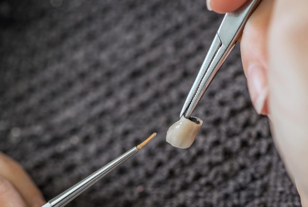 Dental Crowns