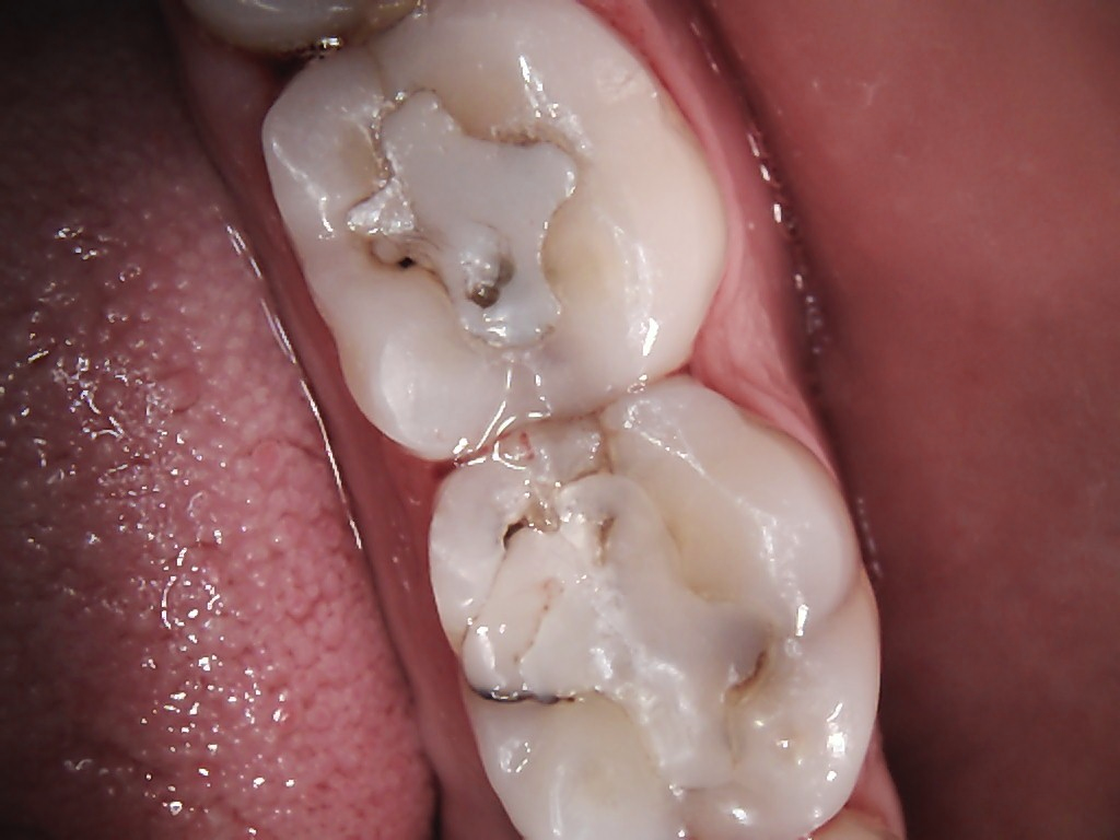 Dental Filling