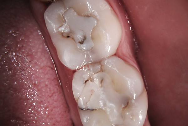 Dental Filling