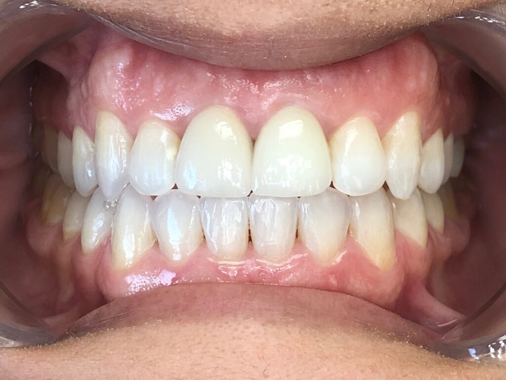 After Treatment
