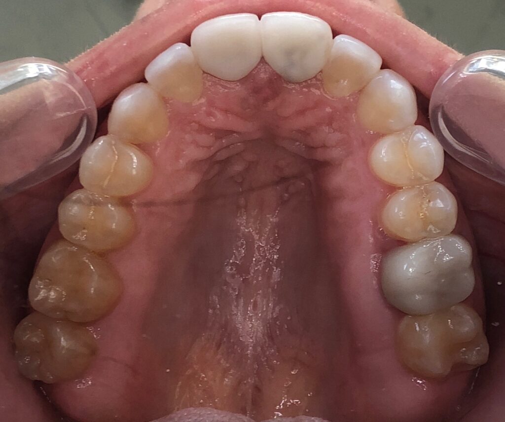 After Deep Cleaning