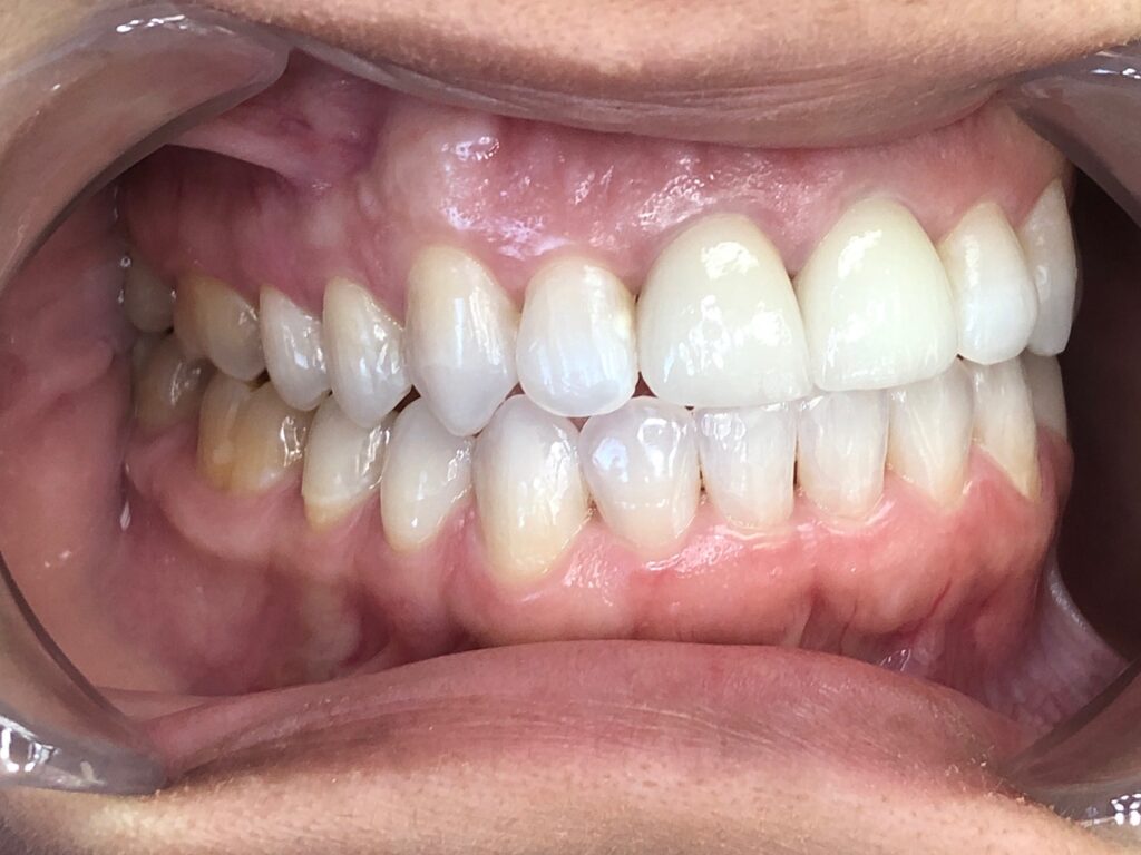 After Teeth Dental Trays