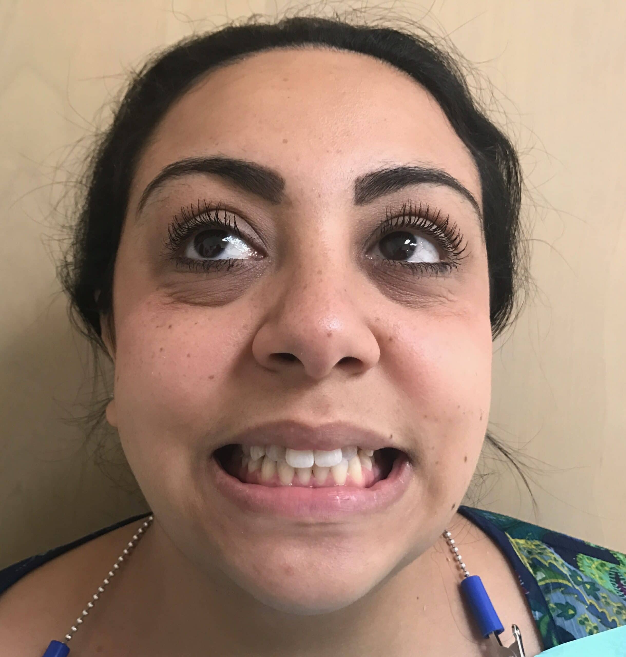 Before Invisalign