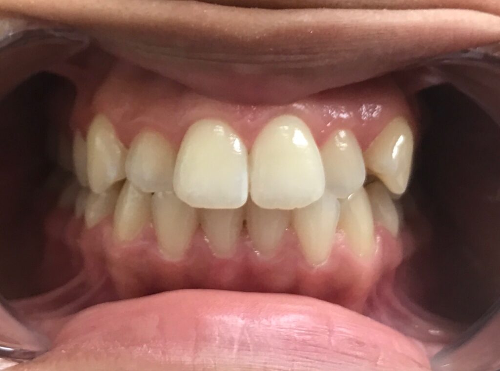 Before Deep Cleaning