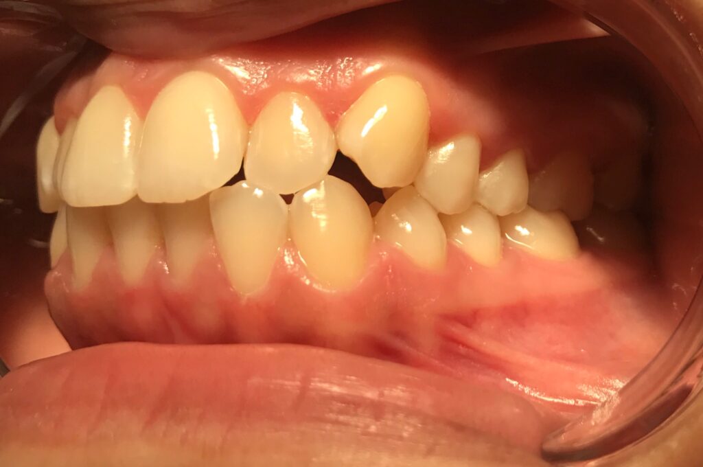 Before Treatment
