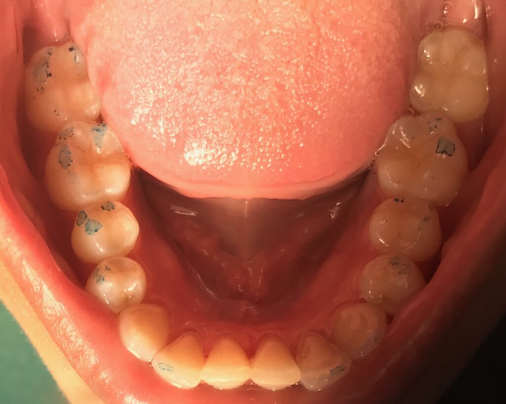 After Treatment
