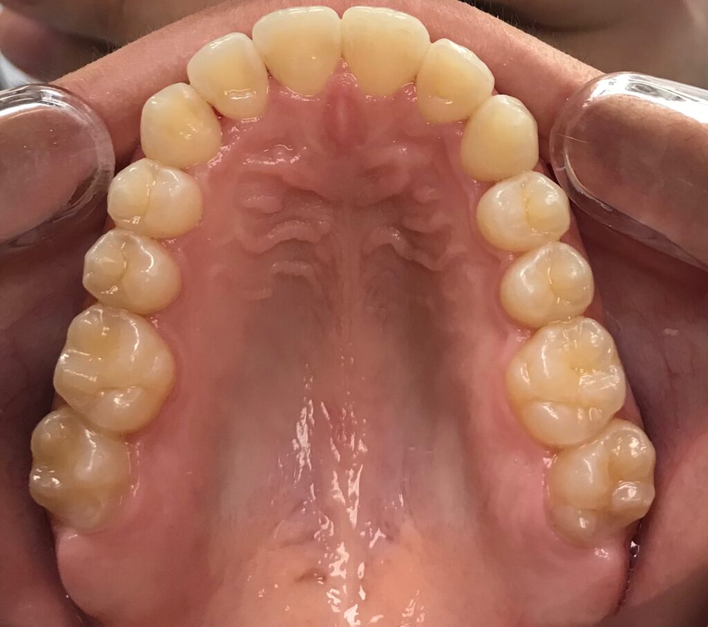 Before Teeth Dental Trays