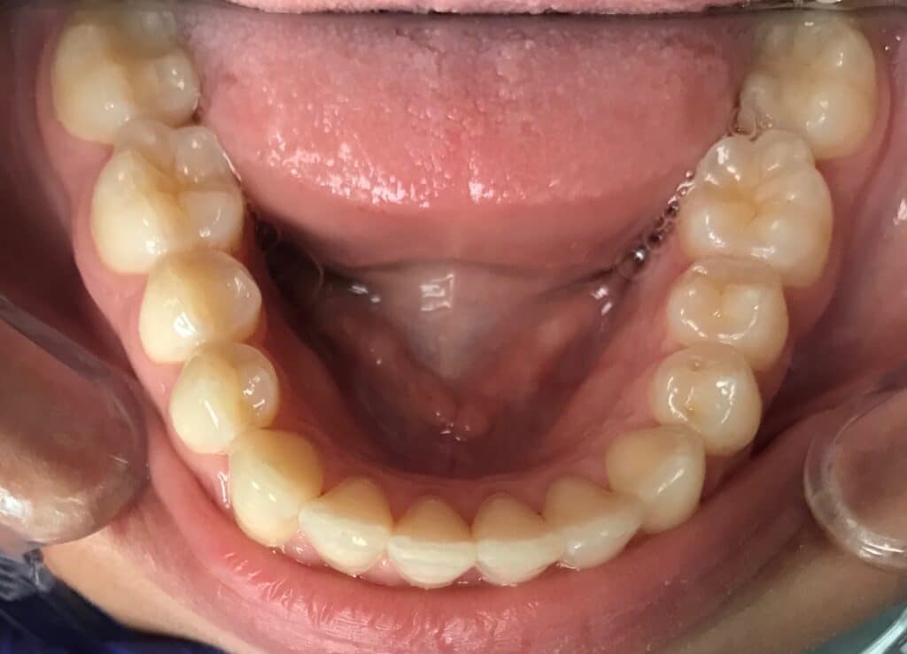 After Teeth Dental Trays