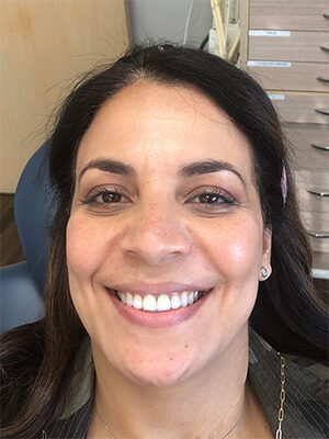 After Invisalign