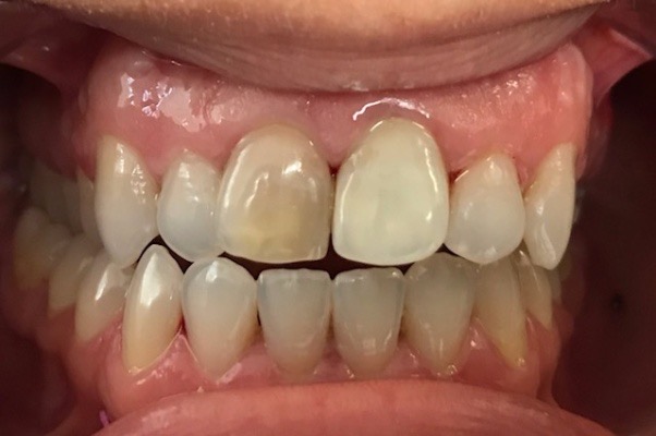 Before Treatment
