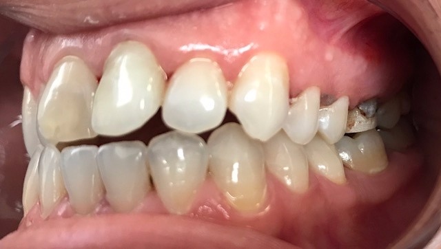 Before Teeth Dental Trays