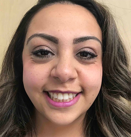 After Invisalign